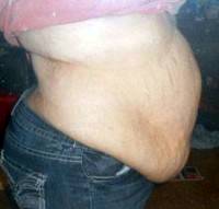 Lose weight before tummy tuck surgery photo before