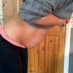 Lose weight before tummy tuck surgery photos