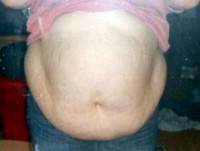 Lose weight before tummy tuck surgery picture