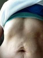 Medical reason for tummy tuck skin removal