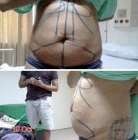 Medical reason for vertical tummy tuck