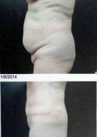 Medically necessary tummy tuck image before and after