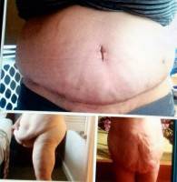 Muscle plication tummy tuck before and after