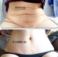 Muscle plication tummy tuck before and after photos