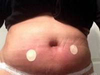Pain after tummy tuck surgery