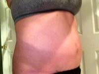 Photo of tummy tuck on thin person