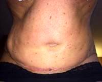 Picture of Low tummy tuck scar gone bad