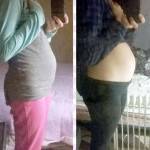 Pregnancy after tummy tuck surgery medical questions