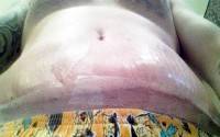 Recovery after a tummy tuck picture