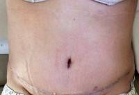 Recovery for a tummy tuck belly button