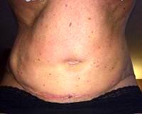 Recovery for a tummy tuck photo