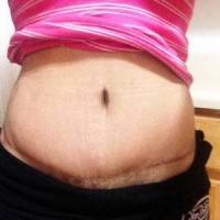 Recovery for a tummy tuck picture