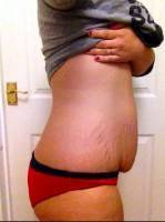 Results of a tummy tuck image