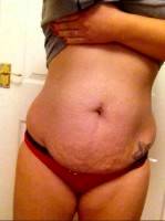 Results of a tummy tuck operation