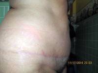 Scar after tummy tuck on thin person