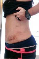 Scarring after tummy tuck procedure