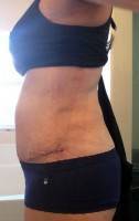 Scarring after tummy tuck surgery