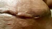 Scars from a tummy tuck image after