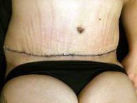 Sex after tummy tuck surgery