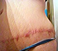 Surgery tummy tuck scar