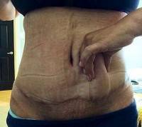 Surgical scar removal image after