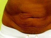 The Tummy tuck on skinny person