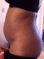 The candidate for Mini Tummy Tuck