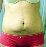 The full tummy tuck with muscle repair