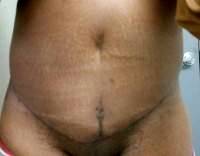 The tummy tuck low scar