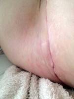 The tummy tuck operation scar