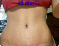 The tummy tuck operation to lose weight