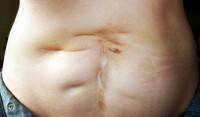 The tummy tuck scar revision surgery