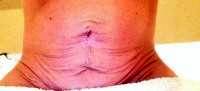 The tummy tuck skin removal