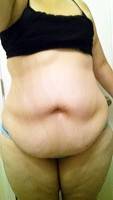 The tummy tuck without muscle tightening