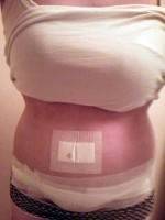 The weight loss tummy tuck before and after image