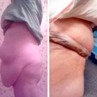 Tummy Tuck after Twins before and after