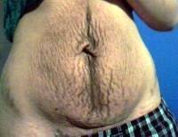 Tummy Tuck and Hysterectomy photo before