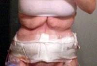 Tummy Tuck for excess skin photo after