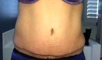 Tummy tuck after pregnancy before and after image