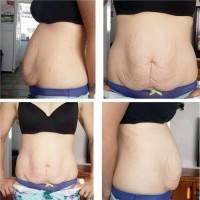 Tummy tuck after pregnancy before and after photo patient