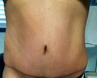 Tummy tuck after pregnancy before and after photos
