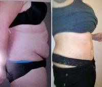 Tummy tuck after pregnancy before and after pictures