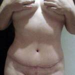 Tummy tuck after pregnancy image
