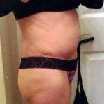 Tummy tuck after pregnancy my pictures