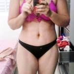 Tummy tuck after pregnancy photo