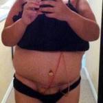 Tummy tuck after pregnancy picture