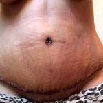 Tummy tuck after pregnancy pictures belly button photo