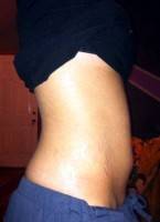 Tummy tuck and stretch marks image