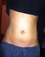 Tummy tuck and stretch marks photo