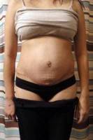 Tummy tuck and weight gain after abdominoplasty